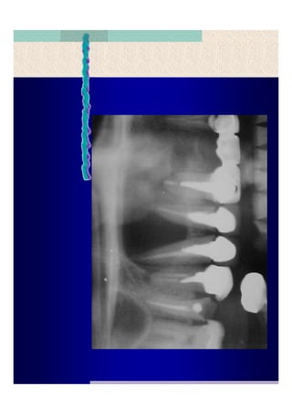 Quistes de la region maxilofacial