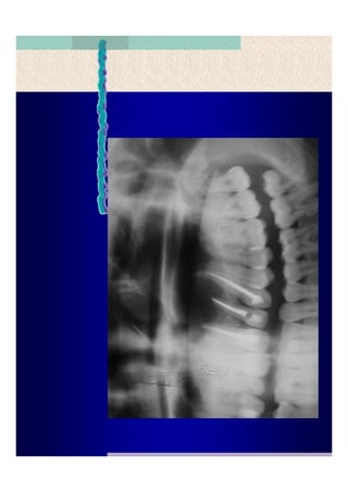 Quistes de la region maxilofacial