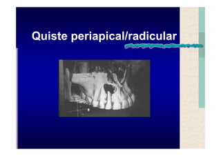 Quistes de la region maxilofacial