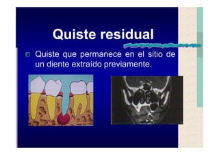 Quistes de la region maxilofacial