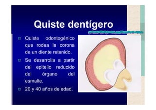 Quistes de la region maxilofacial