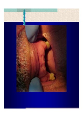 Quistes de la region maxilofacial