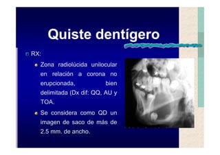 Quistes de la region maxilofacial