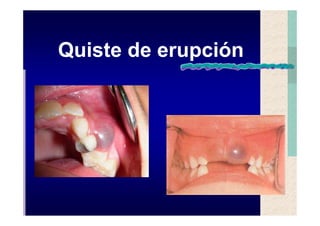 Quistes de la region maxilofacial