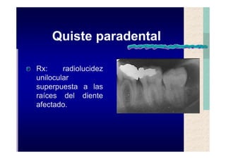 Quistes de la region maxilofacial