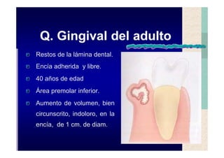 Quistes de la region maxilofacial