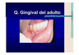 Quistes de la region maxilofacial