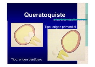 Quistes de la region maxilofacial