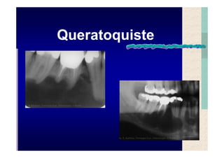 Quistes de la region maxilofacial