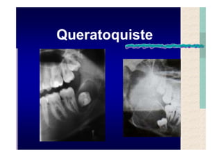Quistes de la region maxilofacial