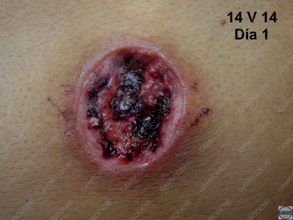 Quiste sebaceo axila_2