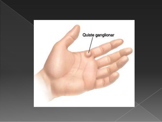 Quistes ganglionares