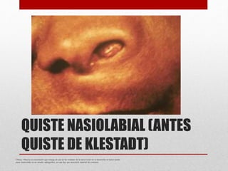 QUISTE NASIOLABIAL (ANTES
QUISTE DE KLESTADT)
Clínica. Observe el crecimiento que emerge de una de las ventanas de la nariz.Como no se desarrolla en hueso puede
pasar inadvertido en un estudio radiográfico, así que hay que inyectarle material de contraste
 