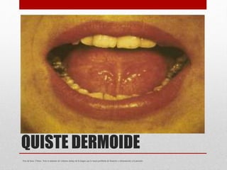 QUISTE DERMOIDE
Piso de boca. Clínica. Note el aumento de volumen debajo de la lengua que le traerá problema de fonación y alimentación a la paciente.
 