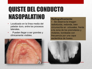 QUISTE DEL CONDUCTO
NASOPALATINO
• Localizado en la línea media del
paladar duro, entre los procesos
laterales.
• Pueden llegar a ser grandes y
clínicamente visibles.
Radiograficamente:
• Se observa la imagen
radiolúcida, redonda, bien
circunscrita en oclusales, frente
a la zona de los premolares y
molares, bordeada con
frecuencia por una capa
esclerótica de hueso.
 