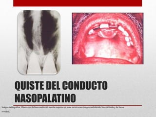 QUISTE DEL CONDUCTO
NASOPALATINO
Imágen radiográfica. Observe en la línea media del maxilar superior en zona incisiva una imagen radiolúcida, bien definida y de forma
ovoidea.
 