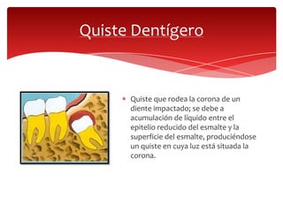 Quiste que rodea la corona de un
diente impactado; se debe a
acumulación de líquido entre el
epitelio reducido del esmalte y la
superficie del esmalte, produciéndose
un quiste en cuya luz está situada la
corona.
Quiste Dentígero
 
