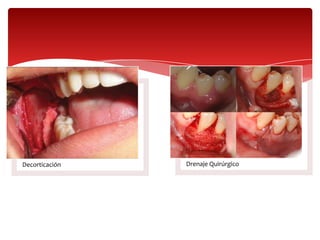 Decorticación Drenaje Quirúrgico
 
