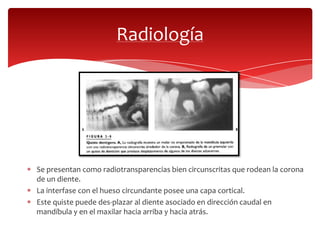 Se presentan como radiotransparencias bien circunscritas que rodean la corona
de un diente.
La interfase con el hueso circundante posee una capa cortical.
Este quiste puede des-plazar al diente asociado en dirección caudal en
mandíbula y en el maxilar hacia arriba y hacia atrás.
Radiología
 