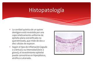 La cavidad quística de un quiste
dentígero está revestida por una
capa relativamente uniforme de
epitelio plano estratificado no
queratinizado, que mide de dos a
diez células de espesor.
Según el tipo de inflamación (aguda
o crónica) y su intensidad (leve a
grave), el revestimiento epitelial
puede convertirse en hiperplásico,
atrófico o ulcerado.
Histopatología
 