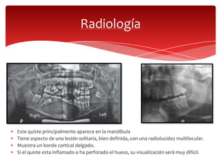 Radiología
Este quiste principalmente aparece en la mandíbula
Tiene aspecto de una lesión solitaria, bien definida, con una radiolucidez multilocular.
Muestra un borde cortical delgado.
Si el quiste esta inflamado o ha perforado el hueso, su visualización será muy difícil.
 