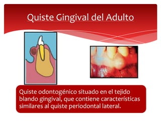Quiste Gingival del Adulto
Quiste odontogénico situado en el tejido
blando gingival, que contiene características
similares al quiste periodontal lateral.
 