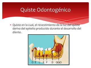 Quiste Odontogénico
Quiste en la cual, el revestimiento de la luz del quiste
deriva del epitelio producido durante el desarrollo del
diente.
 