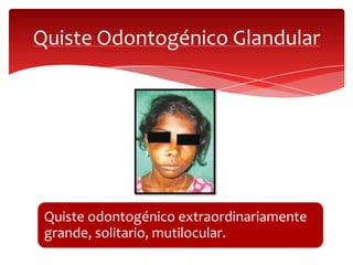 Quiste Odontogénico Glandular
Quiste odontogénico extraordinariamente
grande, solitario, mutilocular.
 