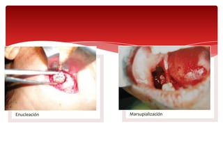 Enucleación Marsupialización
 