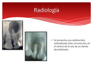 Radiología
Se presenta una radiolucidez
redondeada, bien circunscrita, en
el vértice de la raíz de un diente
desvitalizado.
 
