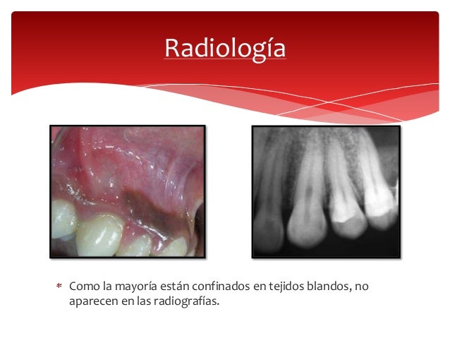 Quistes odontogénicos