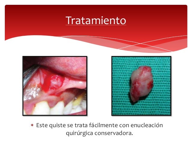 Quistes odontogénicos