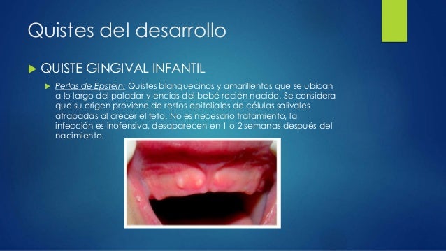 Quistes odontogénicos y no odontogénicos