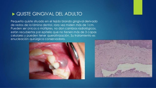 Quistes odontogénicos y no odontogénicos