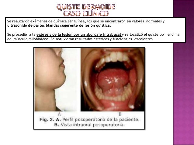 Infeccion viral y bacteriana amigdalas Infeccion viral y bacteriana amigdalas