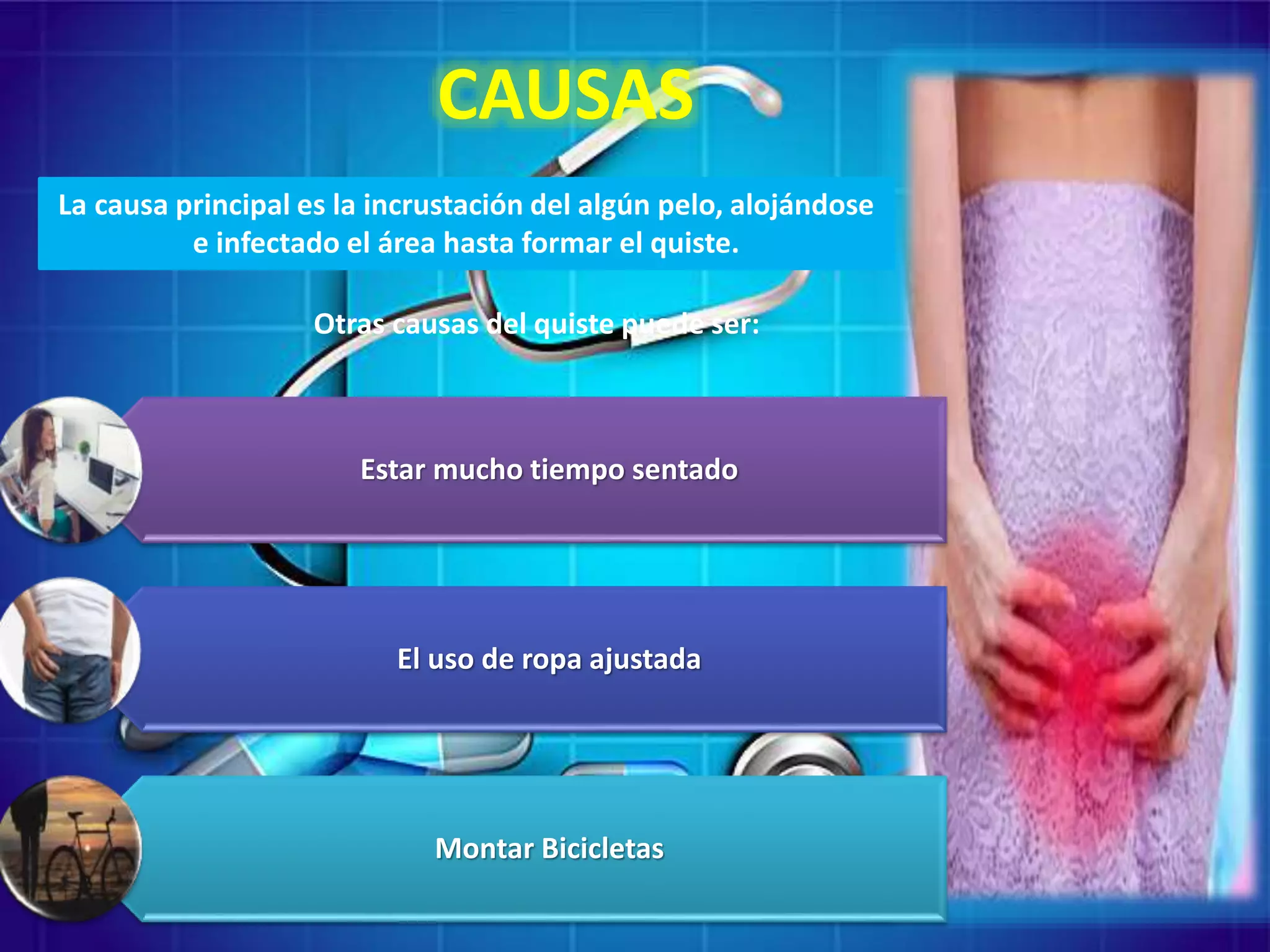 Quistes pilonidal | PPTX