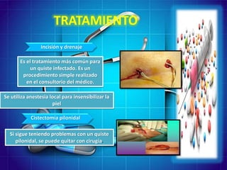 Quistes pilonidal | PPTX