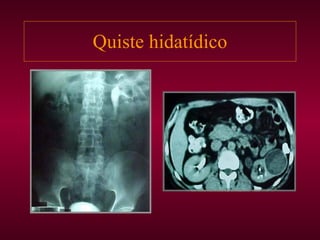 Quiste hidatídico 