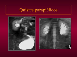 Quistes parapiélicos 