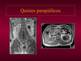 Quistes parapiélicos 