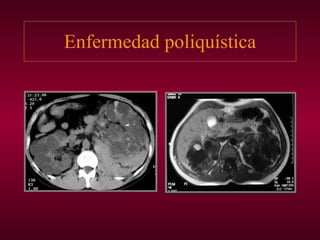 Enfermedad poliquística 