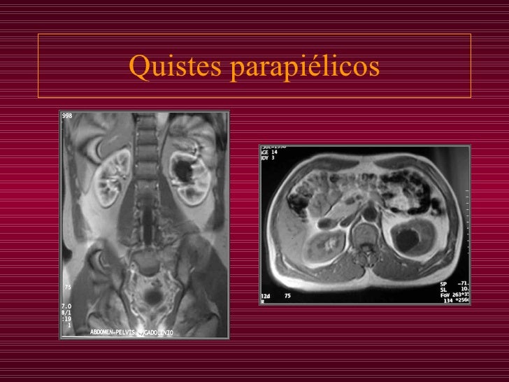 Quistes Renales