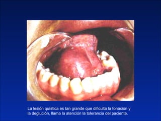 La lesión quística es tan grande que dificulta la fonación y la deglución, llama la atención la tolerancia del paciente. 
