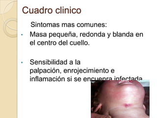 Cuadro clinico
    Sintomas mas comunes:
•   Masa pequeña, redonda y blanda en
    el centro del cuello.

•   Sensibilidad a la
    palpación, enrojecimiento e
    inflamación si se encuenra infectada
 