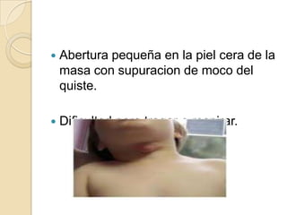    Abertura pequeña en la piel cera de la
    masa con supuracion de moco del
    quiste.

   Dificultad para tragar o respirar.
 