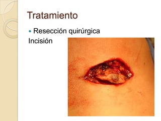 Tratamiento
 Resección quirúrgica
Incisión
 