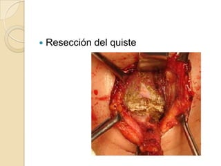    Resección del quiste
 