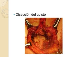    Disección del quiste
 