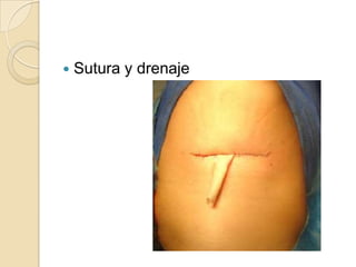    Sutura y drenaje
 