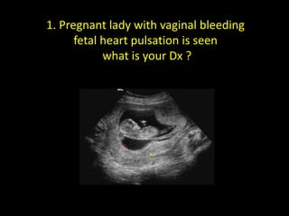 1. Pregnant lady with vaginal bleeding
fetal heart pulsation is seen
what is your Dx ?
 